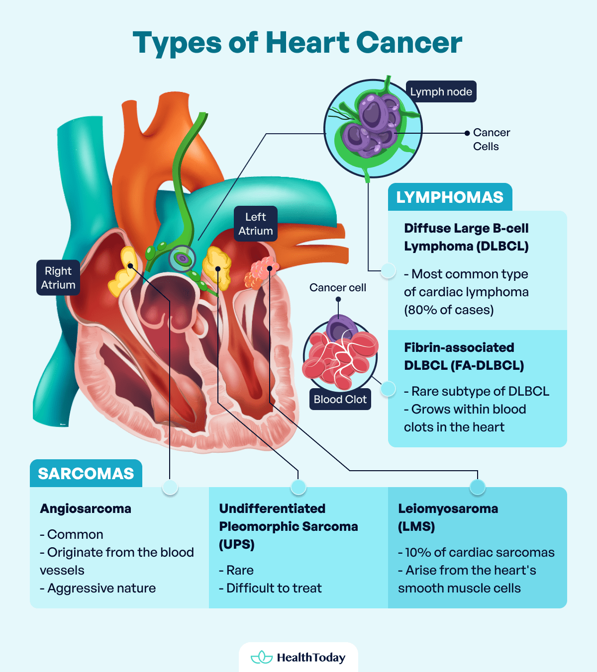 Is There Heart Cancer Types Symptoms Treatments 03