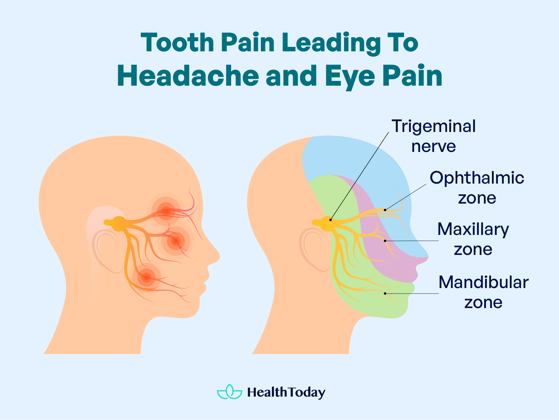 Toothache Causing Headache and Eye Pain 01
