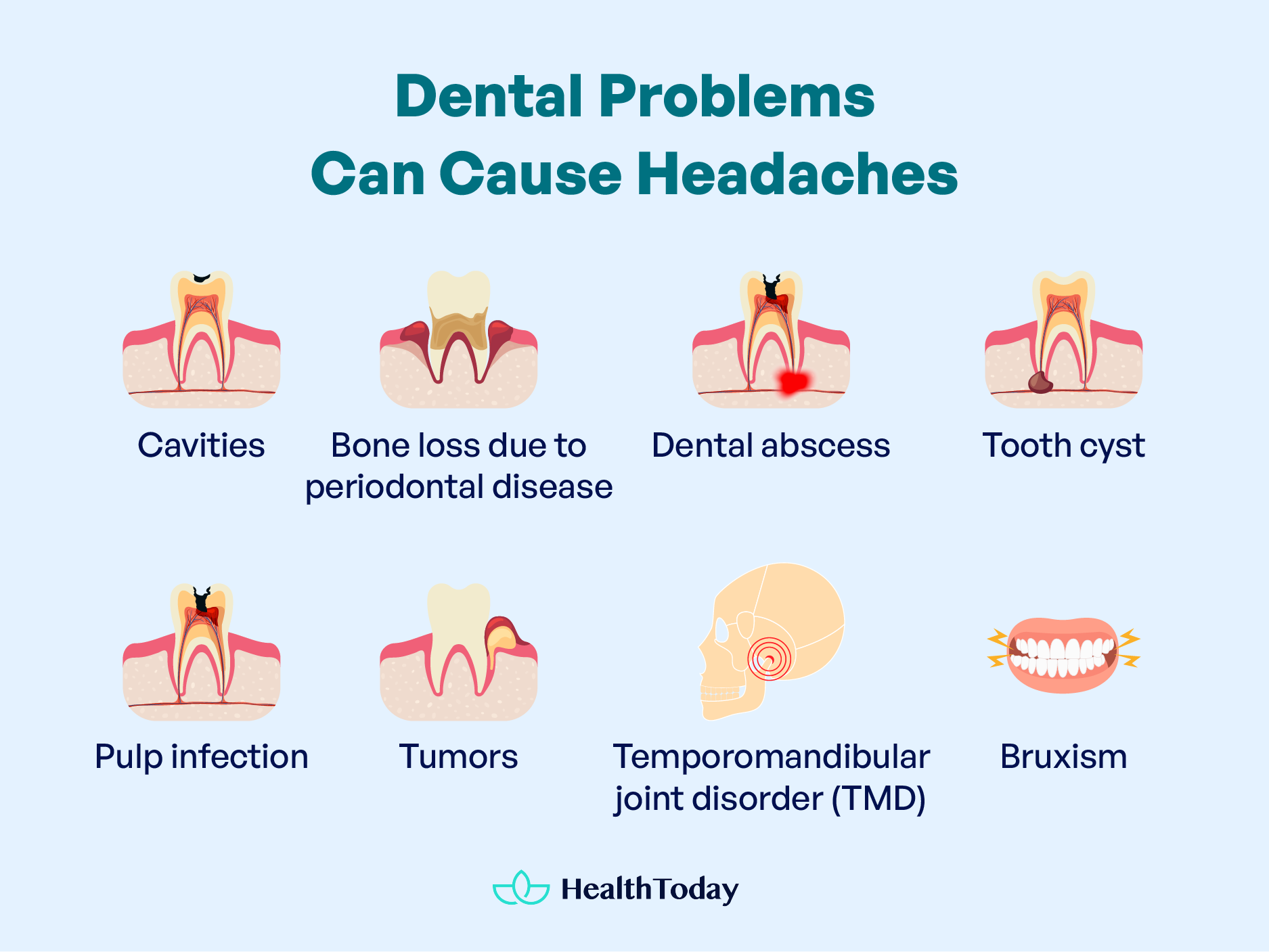 Toothache Causing Headache and Eye Pain 02