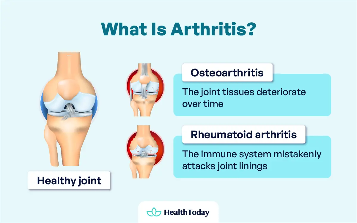 Whats Good For Arthritis Home Remedies Herbs Diet and What To Avoid 01